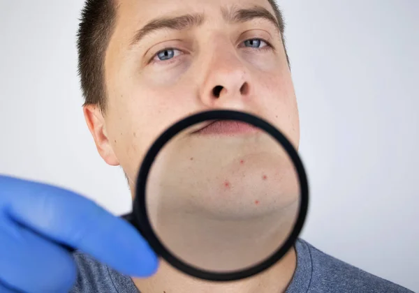 Acne close-up. A man is being examined by a doctor. Dermatologist examines the skin through a magnifier, a magnifying glass