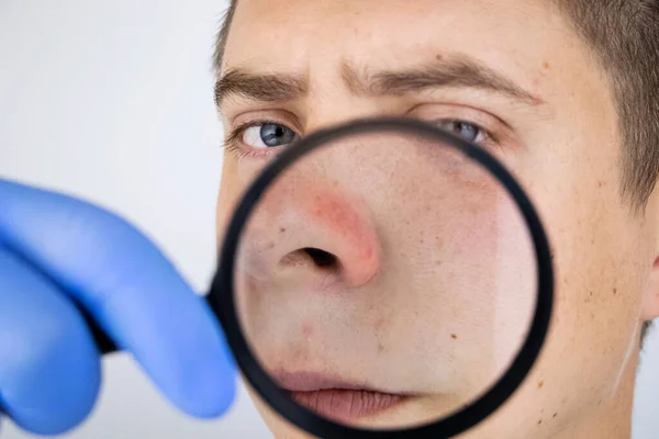Acne Close Man Being Examined Doctor Dermatologist Examines Skin Magnifier — Stock Photo, Image