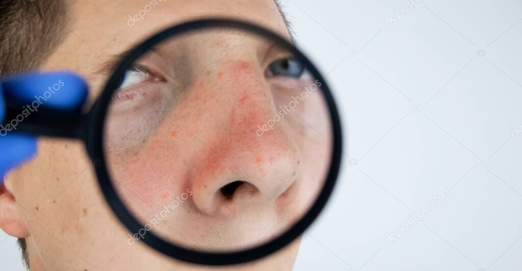 Acne close-up. A man is being examined by a doctor. Dermatologist examines the skin through a magnifier, a magnifying glass