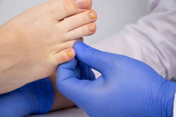 皮肤科医生检查受真菌影响的脚趾甲 真菌病的治疗及对真菌病患者的帮助 — 图库照片