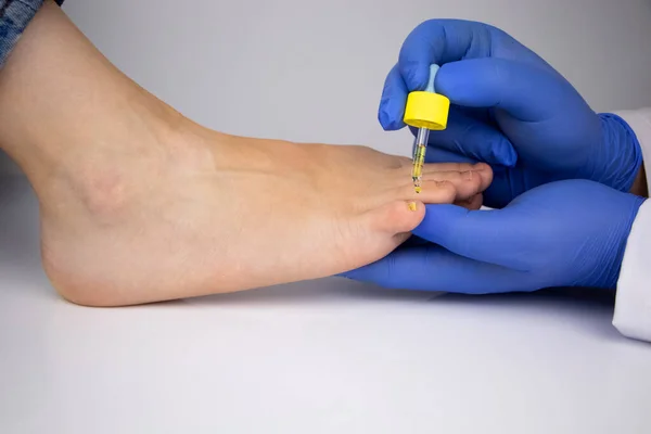 医生的皮肤科医生在受真菌影响的指甲上涂了一个吸盘 把药扔了下去 抗胆怯疗法 念珠菌病的治疗和对真菌病患者的援助 — 图库照片