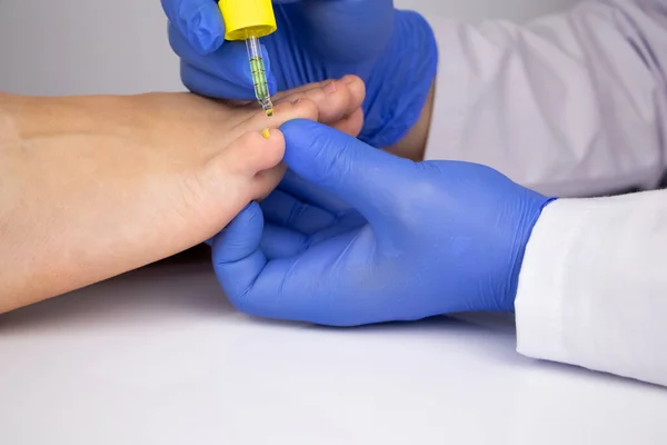 Médecin Dermatologue Laisse Tomber Médicament Avec Une Pipette Sur Ongle — Photo