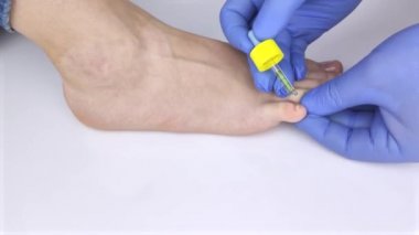 Doktor dermatolog mantardan etkilenen tırnağın üzerinde pipetle ilacı düşürüyor. Antimikotik terapi. Adaylık tedavisi ve mantar hastalığı olan hastalara yardım.