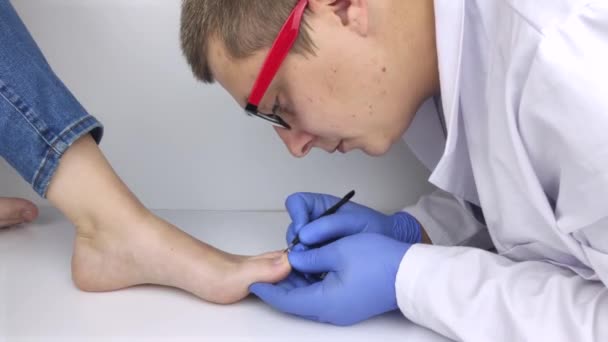 皮膚科医は真菌の影響を受けた爪をきれいにします 対症療法 真菌性疾患の患者へのカンジダ症および支援の治療 — ストック動画