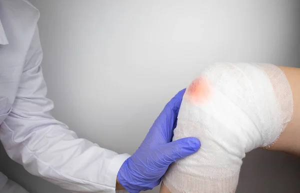 The doctor bandages the knee of a girl who is injured. Stopping bleeding by applying a pressure bandage to the injury. First aid for injuries. The technique of applying a cruciform bandage.