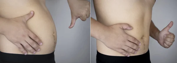 The man shows the results of work on the body. Before and after a thick and thin waist. In the photo on the left, belly fat is visible. In the photo on the right, a thin waist without extra kilograms