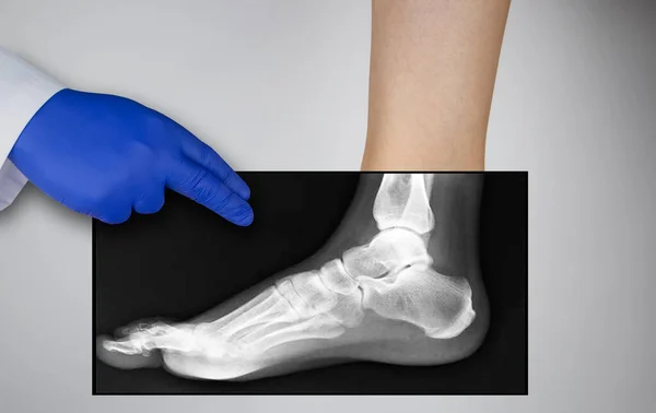女性の足のX線 足の骨の写真が患者の足に適用されます 放射線技師はX線を調べる — ストック写真