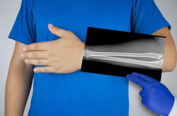 Bir Adamın Kolunun Röntgeni Konuşma Kemiği Dirsek Kemiğinin Bir Fotoğrafı — Stok fotoğraf