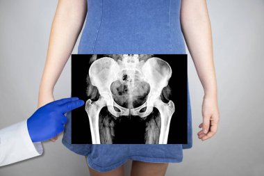 X-ray of the pelvic bones of a woman. Radiologist examines X-ray examination. A picture of the hip joint is superimposed on the patient's body. clipart