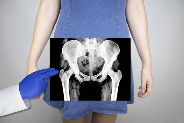 X-ray of the pelvic bones of a woman. Radiologist examines X-ray examination. A picture of the hip joint is superimposed on the patient\'s body.