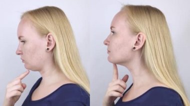 Kadınlarda ikinci çene gerdirme. Estetik ameliyat öncesi ve sonrası fotoğraflar, mentoplasti ya da yüz geliştirme. Çene yağlarını aldırma ve yüz hatlarını düzeltme