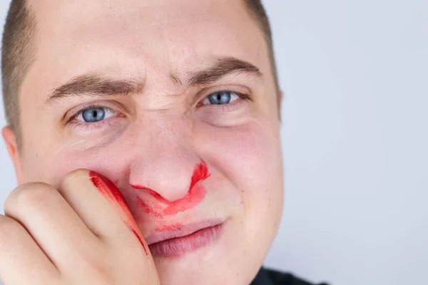 Человека Сломан Нос После Драки Кровь Руках Щеках Носу Последствия — стоковое фото