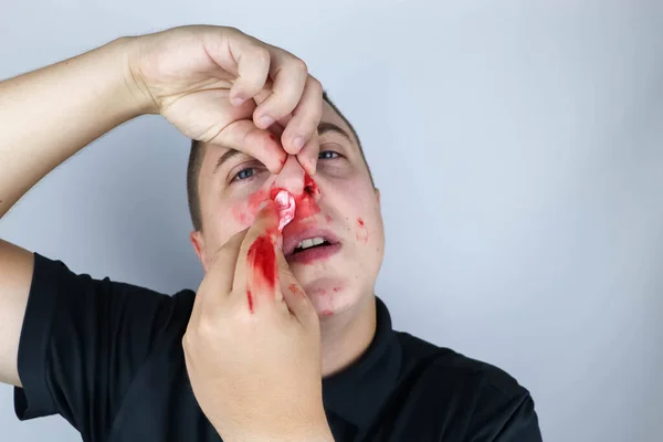Man Has Broken Nose Fight Blood Hands Cheeks Nose Consequences — Stock Photo, Image