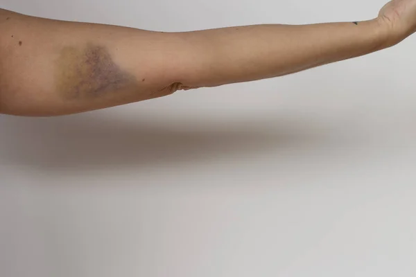 Bruise Hematoma Arm — Stock Photo, Image