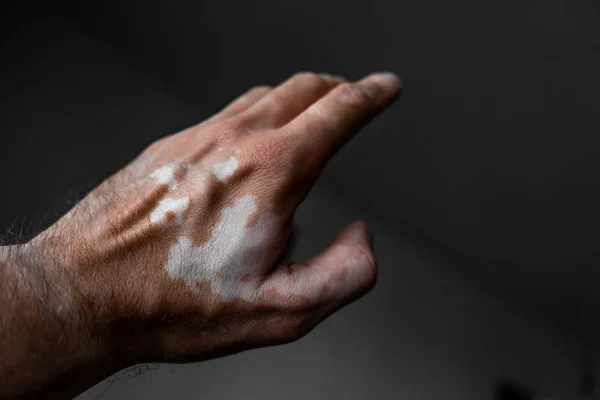The male hand is affected by vitiligo. Health. — Stock Photo, Image