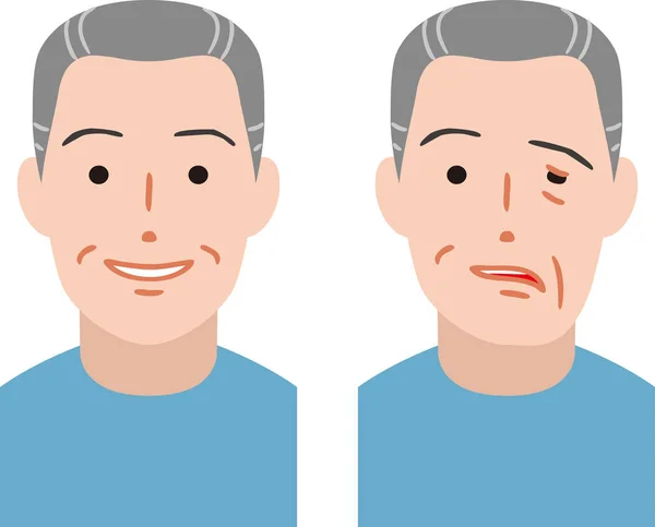 Senior Citizen Facial Nerve Palsy — Stock Vector