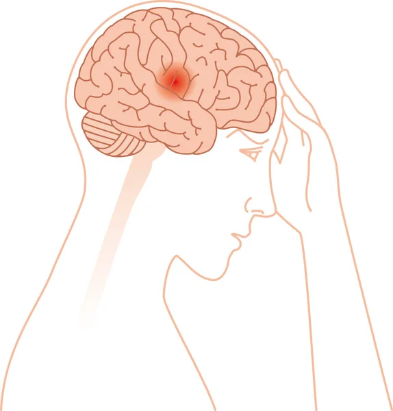 Kopfschmerzen Und Gehirnbild — Stockvektor