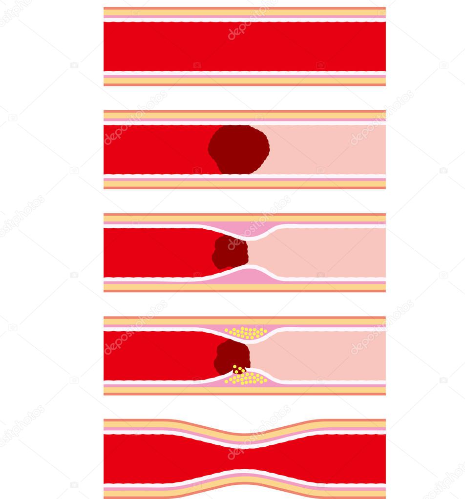 Image of vascular disease such as arteriosclerosis