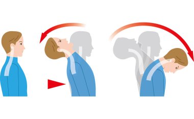 Hareketi nedeniyle boynunun arkasından etkisi. Whiplash yaralanma.