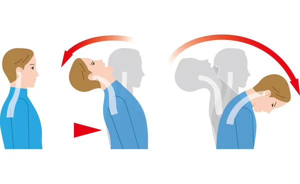 Bewegung Des Nackens Aufgrund Des Aufpralls Von Hinten Schleudertrauma — Stockvektor