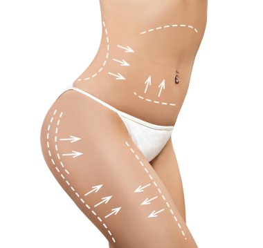 Kadın vücut, estetik tıp kavramı. Kadın kalça çizim oklarla. Yağ kaybetmek, liposuction ve selülit kaldırma kavramı