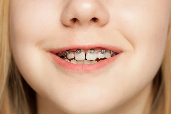 Adolescente Sourire Avec Des Bretelles Sur Les Dents — Photo