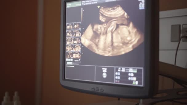 Γωνία κλίσης Shot of a Fetus on a Sonogram Monitor — Αρχείο Βίντεο