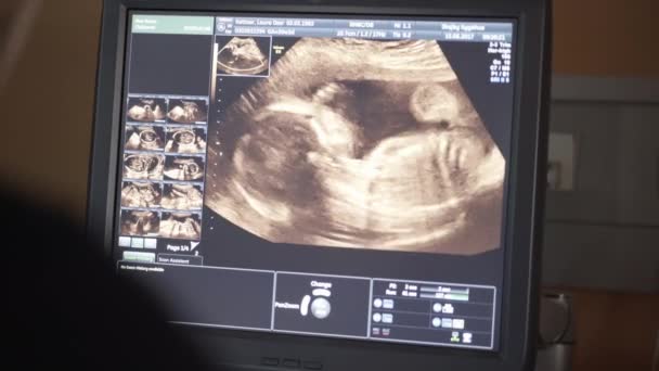 Gericht schot van een echografie Video van een baby met behulp van een Sonogram Machine — Stockvideo