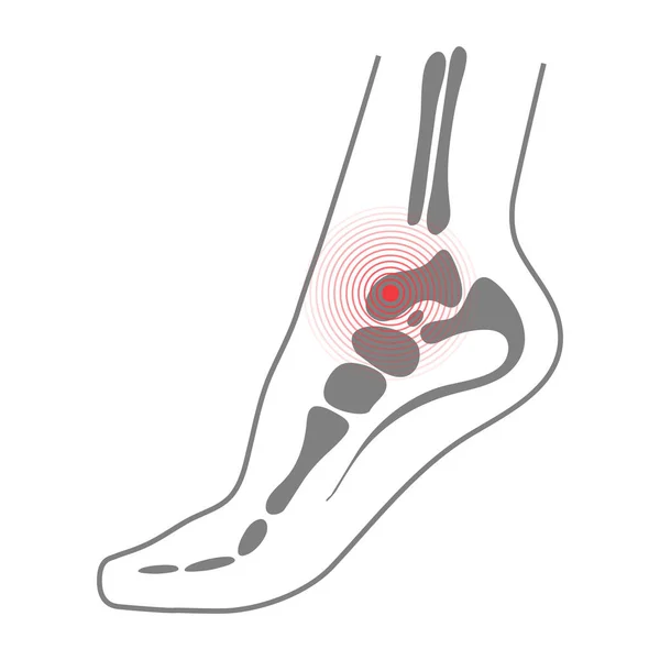 Stopy podeszwa z ilustracja kości dla biomechaniki, obuwie, buty pojęć, medycyna, zdrowie, masaż, Spa, akupunktura centra itp ból koncepcja na białym tle na białym tle. Ilustracja wektorowa. — Wektor stockowy