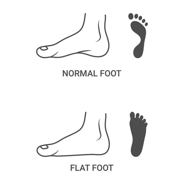 Patologie del piede, normale, piede piatto isolato su sfondo bianco. Illustrazione vettoriale . — Vettoriale Stock