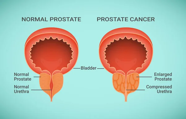 Porównanie ilustracji zdrowy i raka prostaty — Wektor stockowy