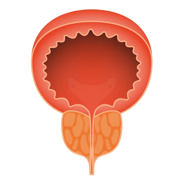 Akut prostatit på vit bakgrund. Mäns reproduktionssystem sjukdom. Medicinsk vektor illustration. — Stock vektor