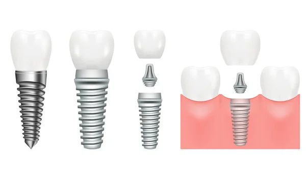 Realistická struktura zubního implantátu se všemi částmi, korunka, šroub. Stomatologie. Implantace lidských zubů. Vektorová ilustrace — Stockový vektor