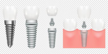 İnsan dişleri ve diş implantı kesme şeması, vektör illüstrasyon. Tüm parçaları taç, abutment, vida ile dental implant yapısı. tıbbi resimsel.