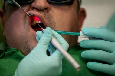 Bucharest, Romanya - 5 Şubat 2019: Ayrıntılar bir hasta ağız içinde lazer cihazları ile çalışan bir kadın dişçiyle, cerrahi eldiven, el ile