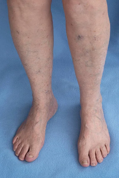Варикозные вены на старых женских ногах. Флебология — стоковое фото