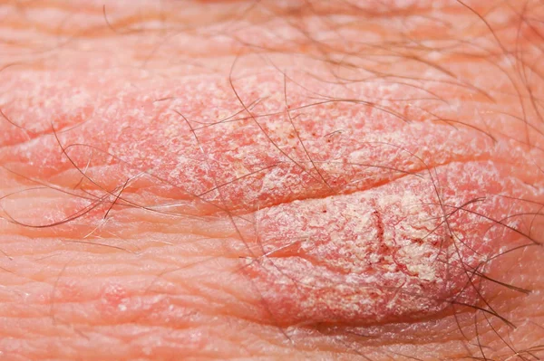 Psoriasis seca irritación roja y blanca en el primer plano de la piel . —  Fotos de Stock