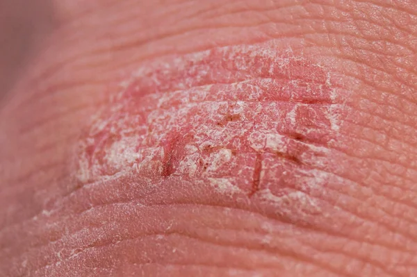 Psoríase irritação vermelha e branca seca no close-up da pele . — Fotografia de Stock