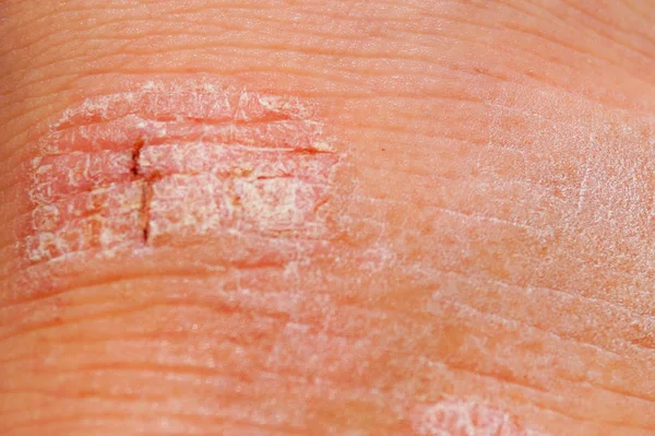 Psoriasis trocknen rot-weiße Reizungen auf der Haut Nahaufnahme. — Stockfoto