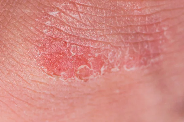 Psoriasis trocknen rot-weiße Reizungen auf der Haut Nahaufnahme. — Stockfoto