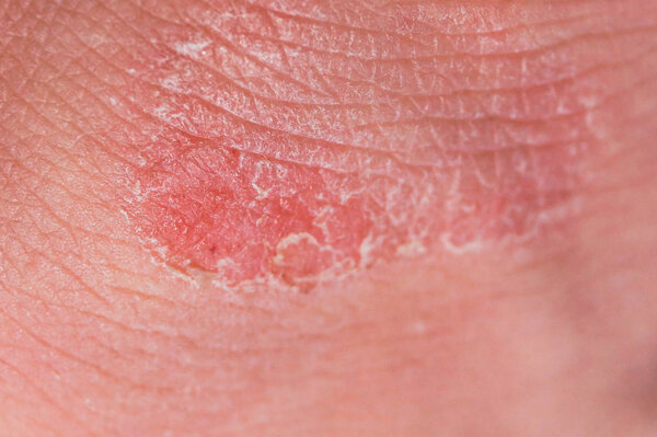 Psoriasis dry red and white irritation on the skin closeup.