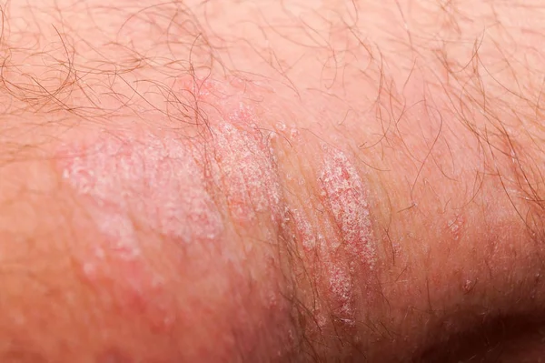 Psoriasis irritation rouge et blanche sèche sur la peau gros plan . — Photo