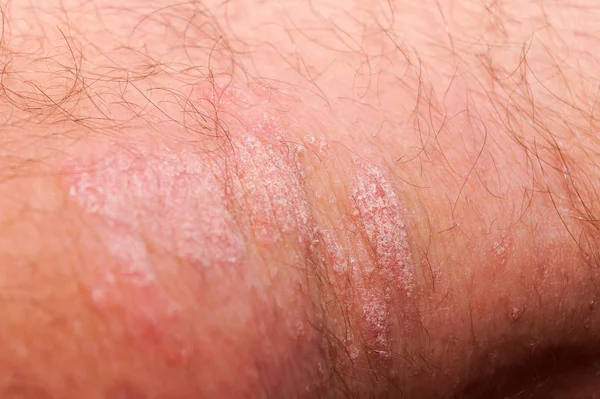 Psoríase irritação vermelha e branca seca no close-up da pele . Imagens De Bancos De Imagens Sem Royalties