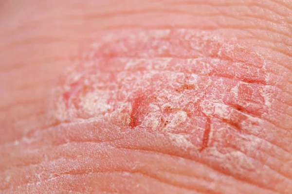 Psoriasis seca irritación roja y blanca en el primer plano de la piel . —  Fotos de Stock