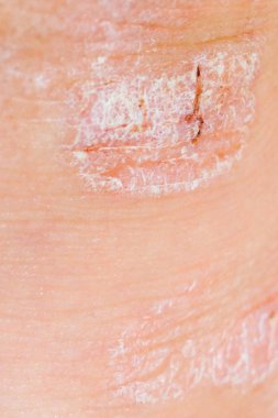 Sedef kuru kırmızı ve beyaz tahriş cilt portre üzerinde.