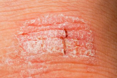 Psoriasis dry red and white irritation on the skin closeup. clipart