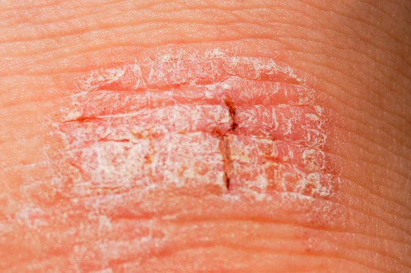 Psoriasis irritation rouge et blanche sèche sur la peau gros plan . — Photo