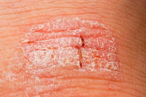 Psoriasis droge rode en witte irritatie op de huid-closeup. — Stockfoto