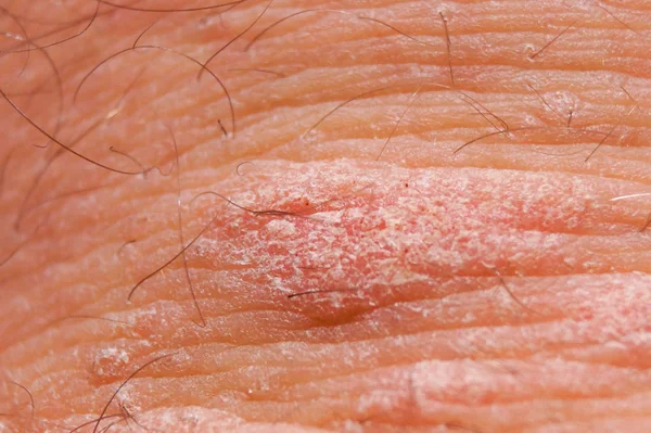 Psoriasis irritation rouge et blanche sèche sur la peau gros plan . — Photo