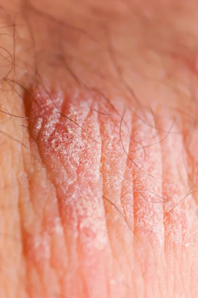 Psoriasis seca irritación roja y blanca en el primer plano de la piel . — Foto de Stock